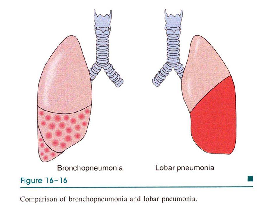 Возможно ли защитить телят от бронхопневмонии?